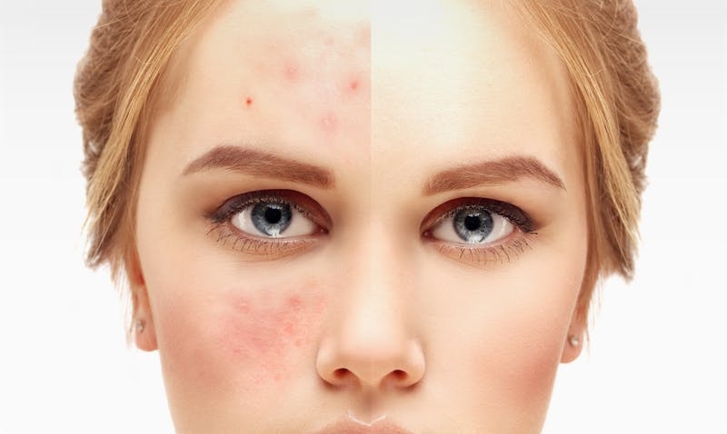 công dụng khác của azelaic acid