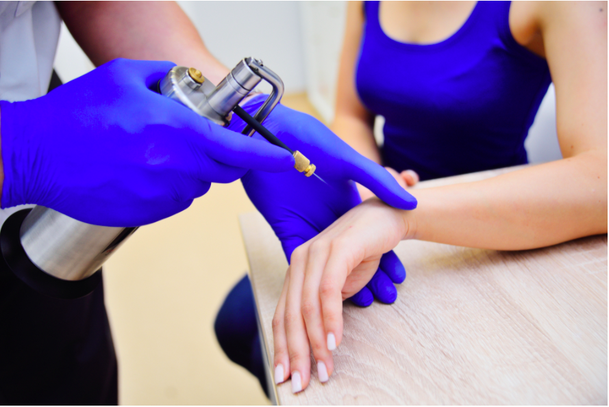 Chữa mụn cóc bằng phương pháp phẫu thuật lạnh (cryosurgery)