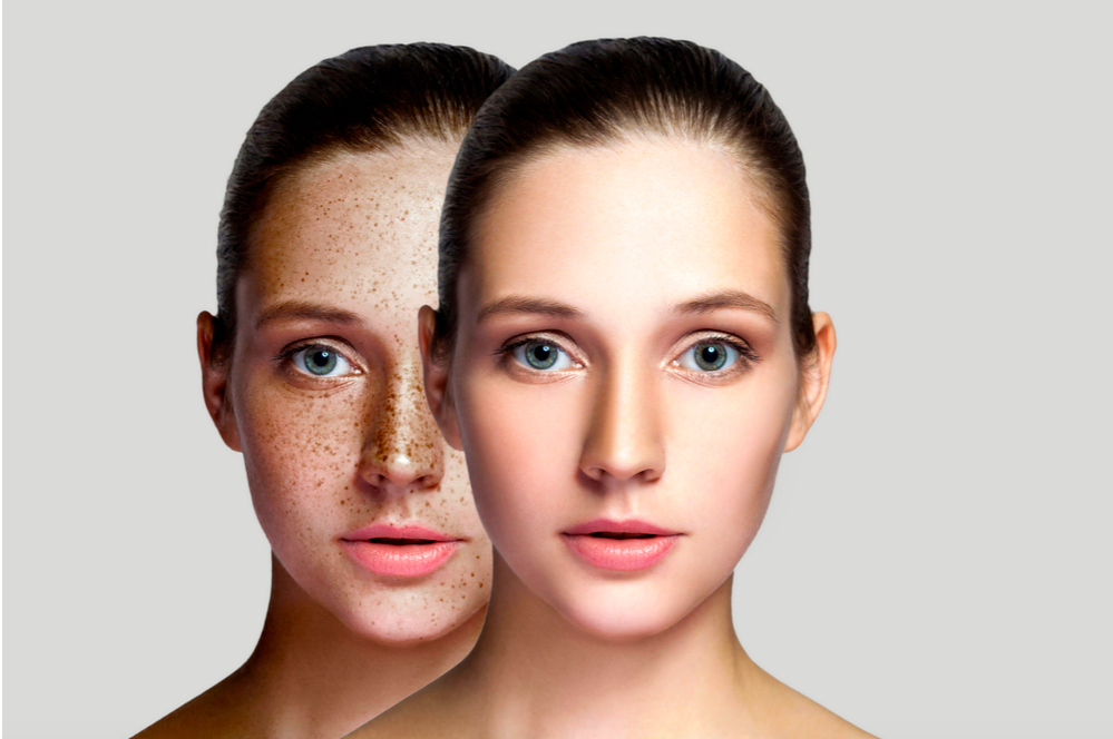 Có nên trị tàn nhang bằng tia laser