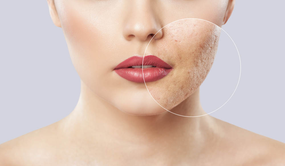Mụn ẩn có tự hết không?