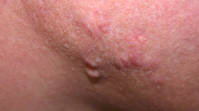 mụn ẩn có nên nặn không
